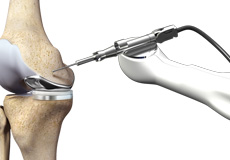 Robotic Partial  Knee Replacement