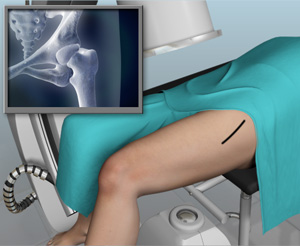Minimally Invasive Anterior Hip Replacement With X-ray Guidance