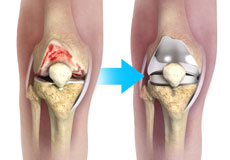 Complex Total Knee Replacement