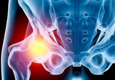 Hip Injury