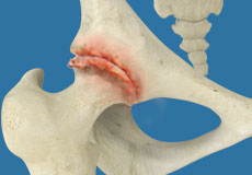 Hip Osteonecrosis