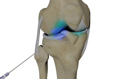 Intraarticular Knee Injection