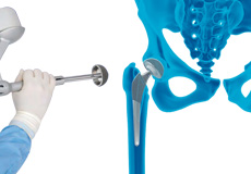 Robotic Hip Replacement