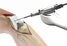 Robotic Knee Replacement