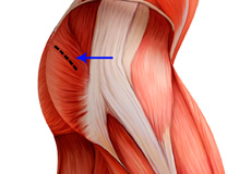 Mini-Posterior Hip Replacement