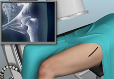 Minimally Invasive Anterior Hip Replacement with X-Ray Guidance