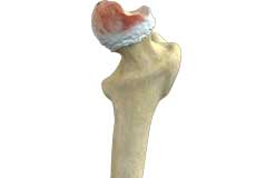 Osteoarthritis of the Hip