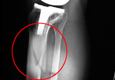 Periprosthetic Knee Fractures