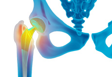 Revision Hip Replacement