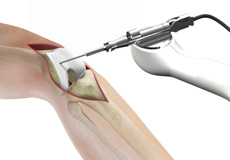 Robotic Assisted Knee Replacement