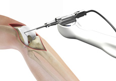 Robotic-Assisted Partial Knee Surgery