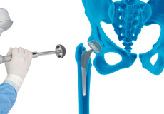 Robotic Total Hip Replacement