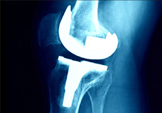 Second Opinion on Joint Replacement & Complex Revisions