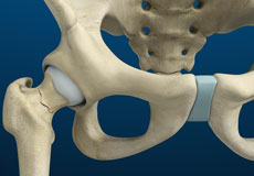 Stress Fractures of the Hip