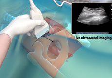 Ultrasound-Guided Hip Injections