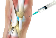 Viscosupplementation aka Gel shots